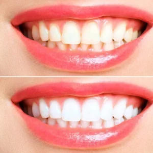 Dental veneers