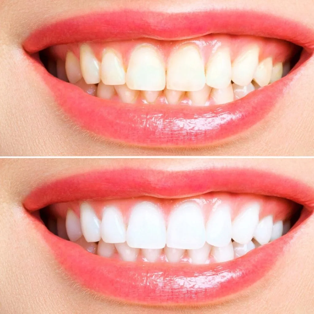 Dental veneers